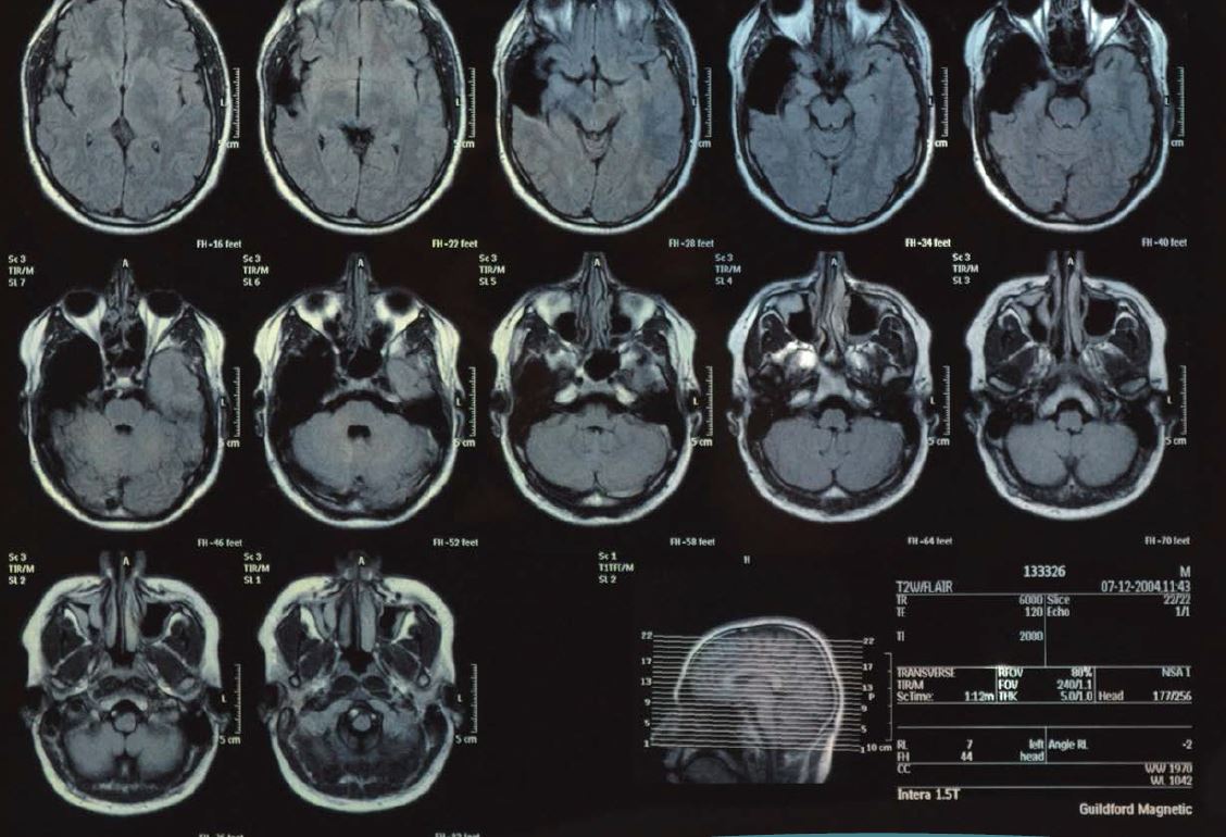 How Long Can You Live With Stage 3 Brain Tumor