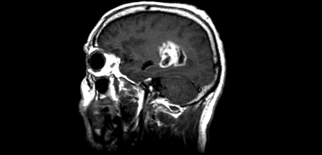 X-ray of a human skull showing a brain tumour