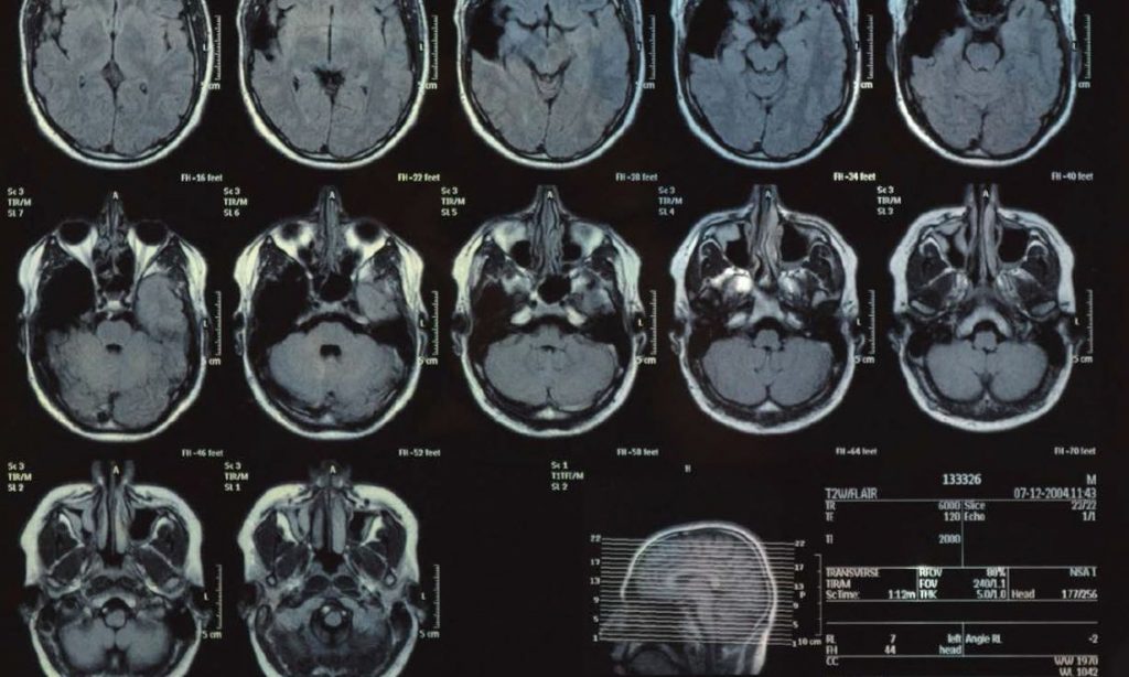 A black and white image of brains scans