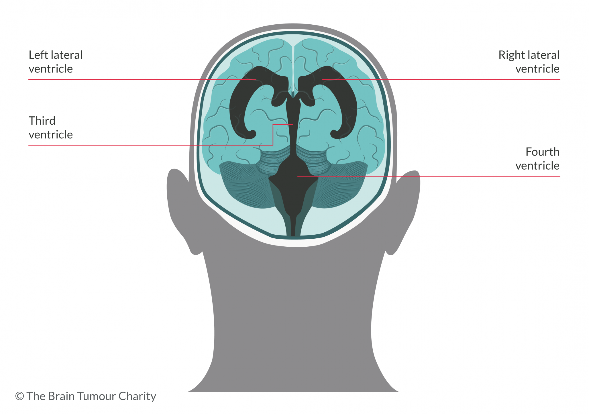 cross section vector image of the human brain showing how a pineoblastoma brain tumour might cause side effects