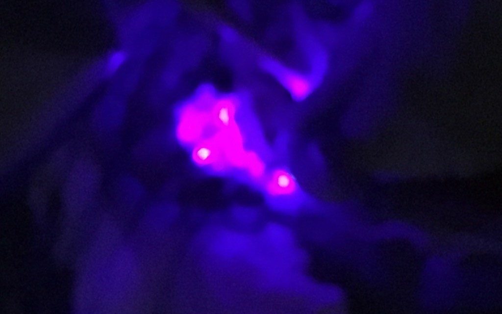 A brain tumour glowing pink under UV light, due to the effects of 5-ALA, or the "Pink Drink"