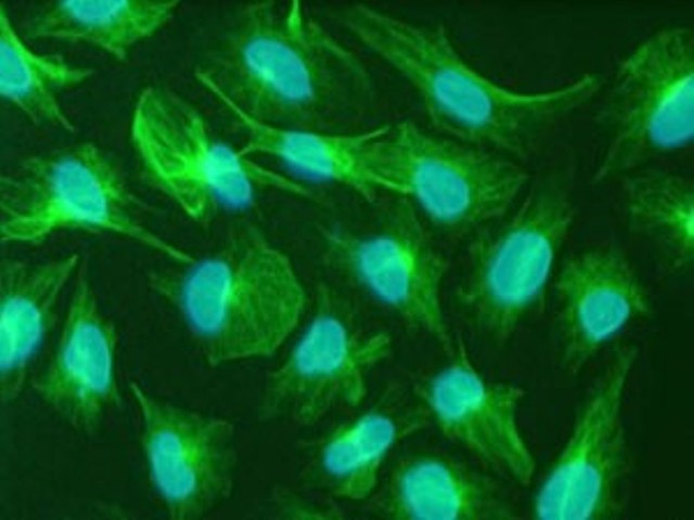 Microscopic view of CED chemotherapy drug used in emerging treatments for brain tumours