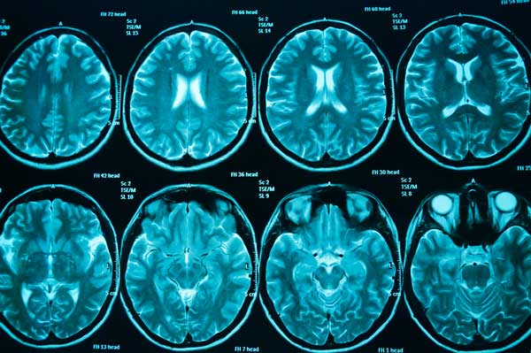 Brain tumour diagnosis The Brain Tumour Charity