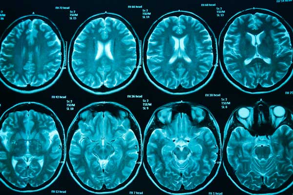 Brain Cancer Screening