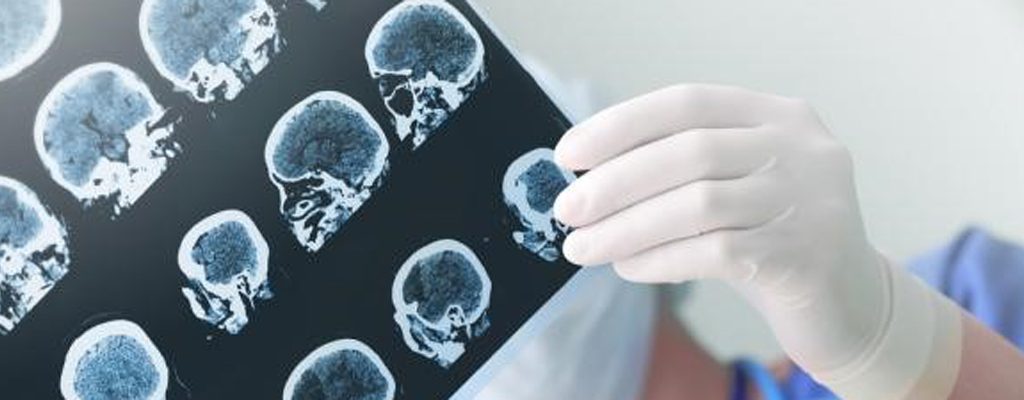 Research reveals new therapeutic target to treat brain cancer  
