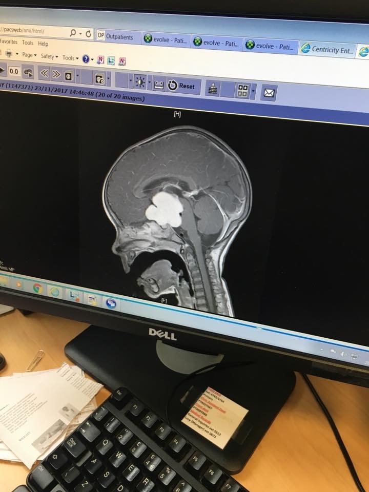 scan showing a brain tumour appearing on a computer screen, campaigning for faster brain tumour diagnosis