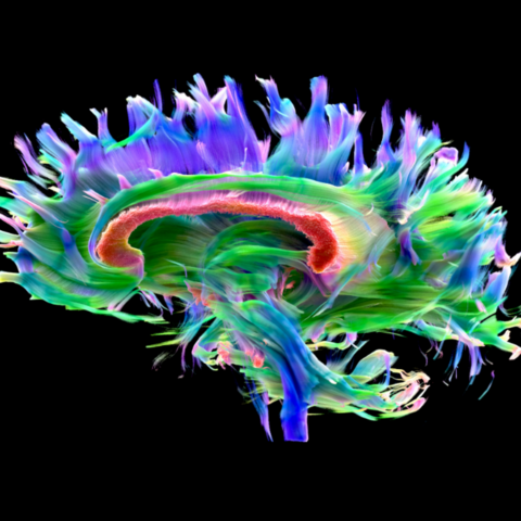 Saggital White Matter Tracts (Seimens Health Care)