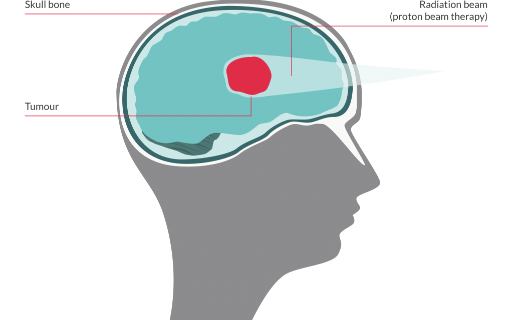 Vector image showing how proton beam therapy works on a brain tumour - the beam stops just after the tumour