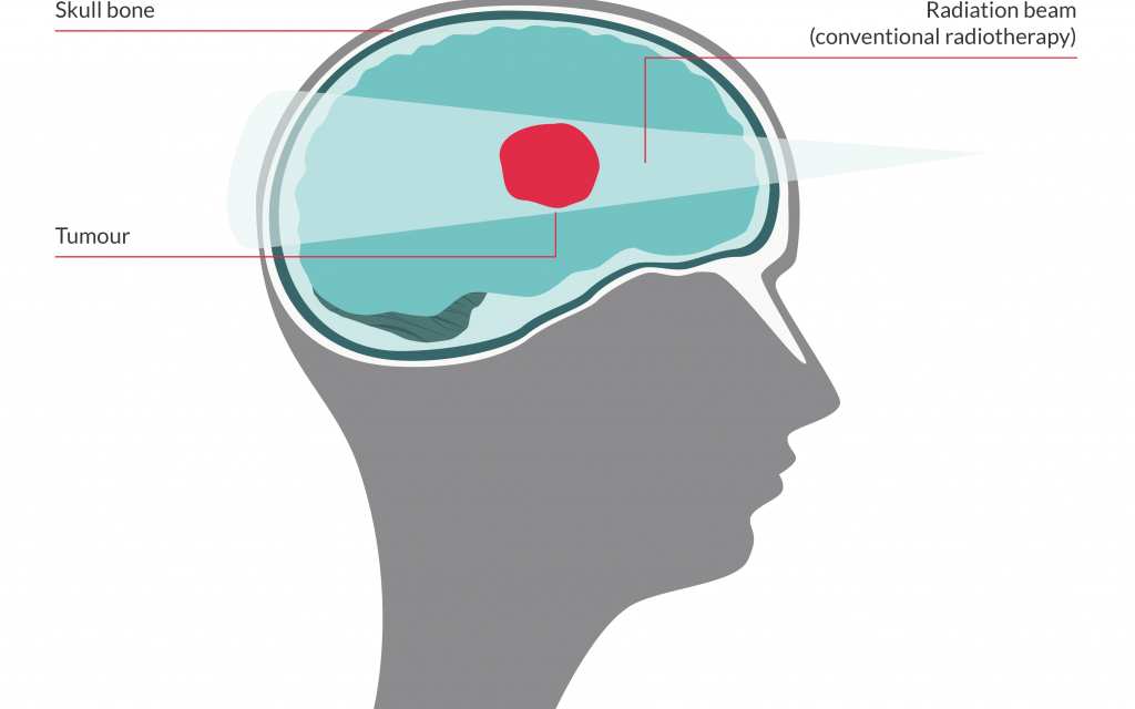 Vector image showing how conventional radiotherapy works on a brain tumour - the beam continues through the brain