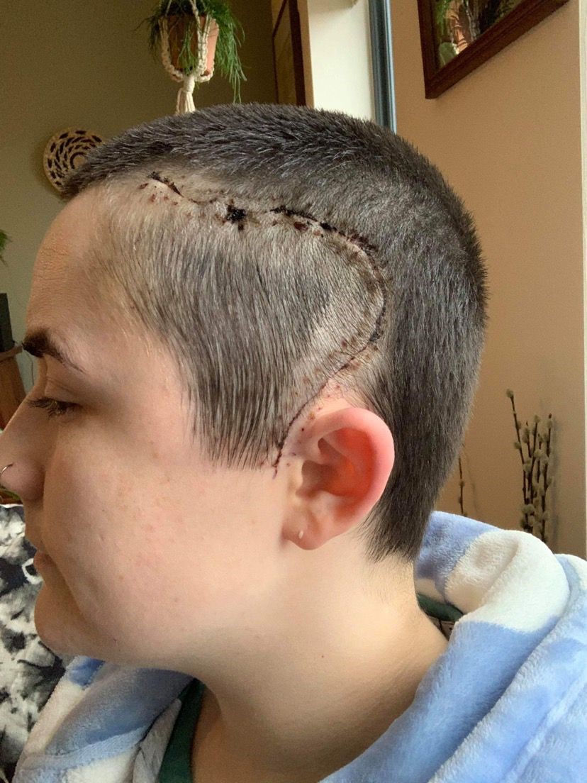 Mia's surgery scar. She underwent a craniotomy to remove her brain tumour, where it was diagnosed as a glioblastoma.