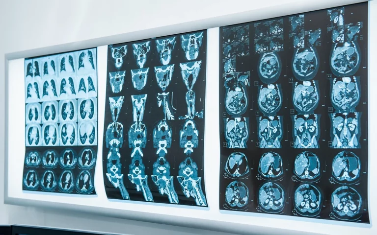 Brain tumour imaging being used to attempt to find out what causes brain tumours