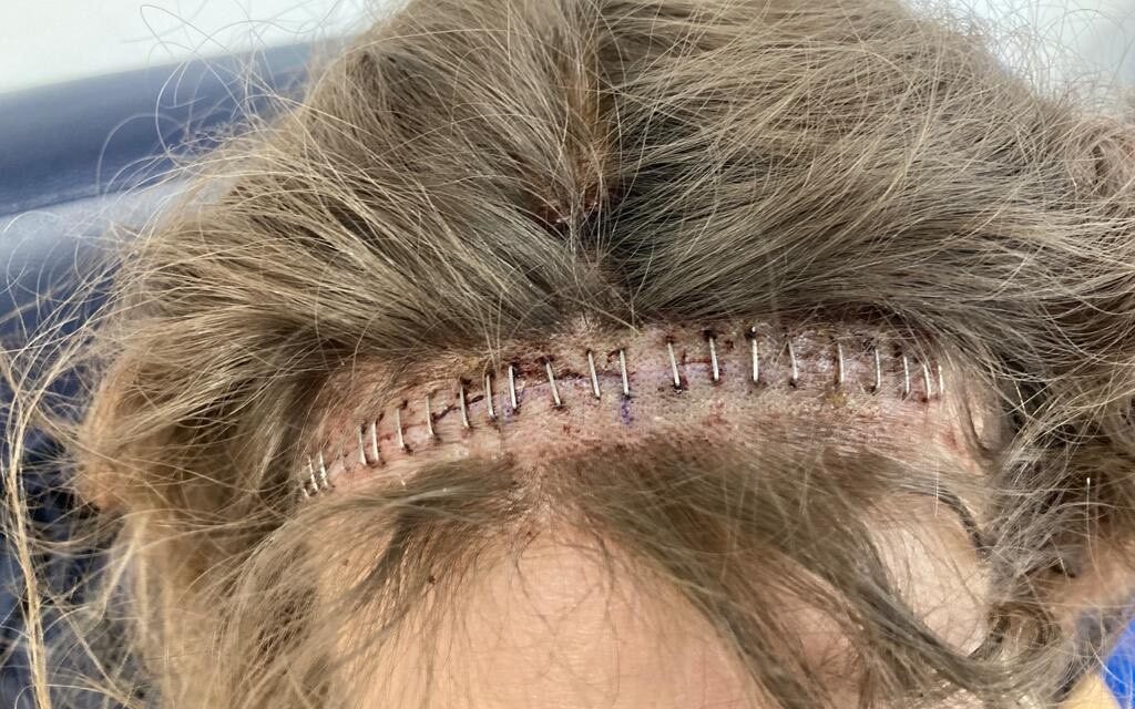 A stapled surgical cut following the removal of parts of a brain tumour