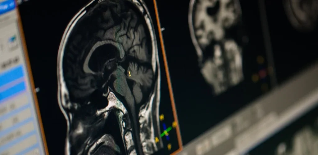 Can a brain tumour be secondary cancer?