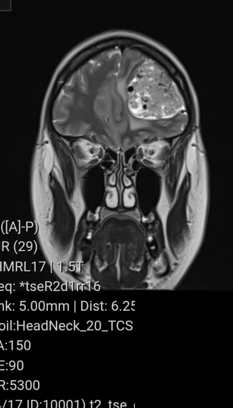 Black and white image of an MRI scan