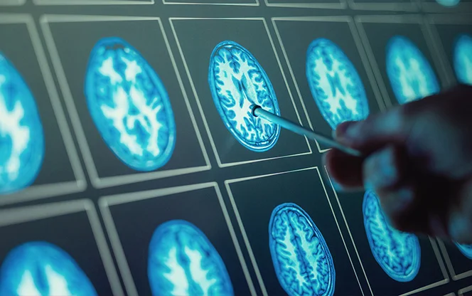 A pen pointing to brain scans on a screen