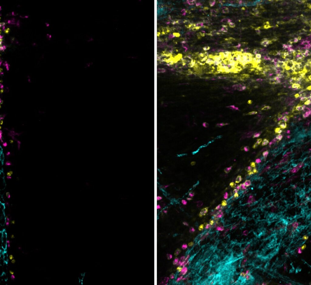 Immune insights could lead to kinder treatments for childhood brain cancer 