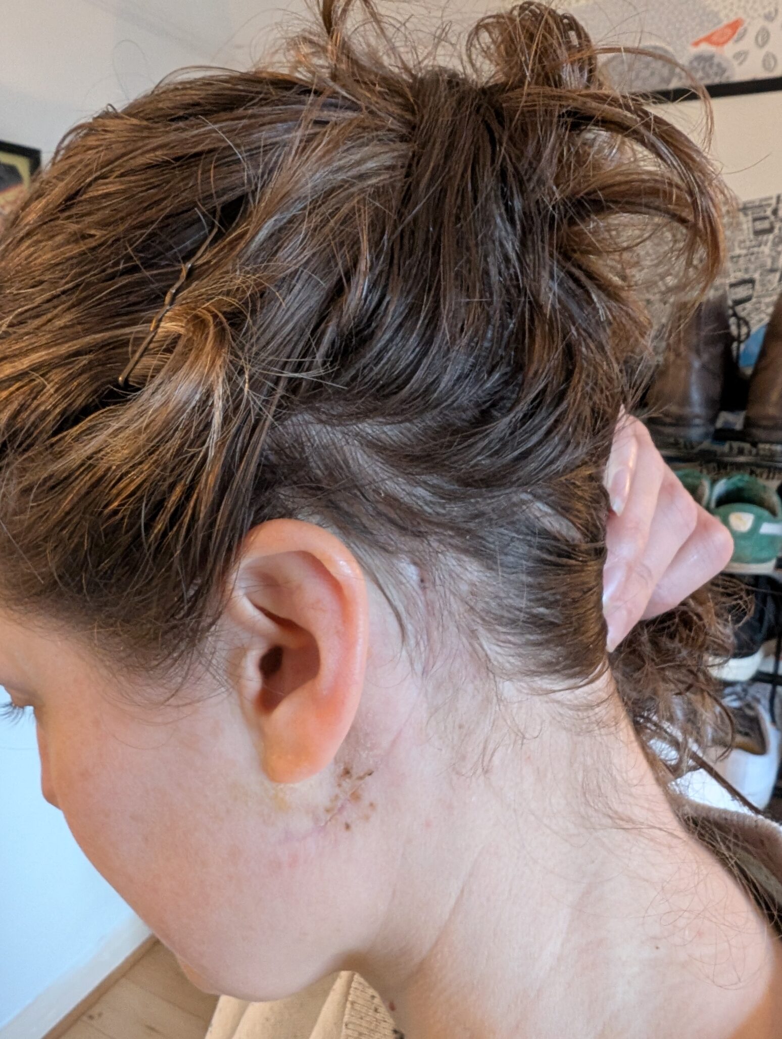 One of the London Marathon 2026 runners holds her hair away from the left side of her head, showing the effects of her brain tumour during her diagnosis
